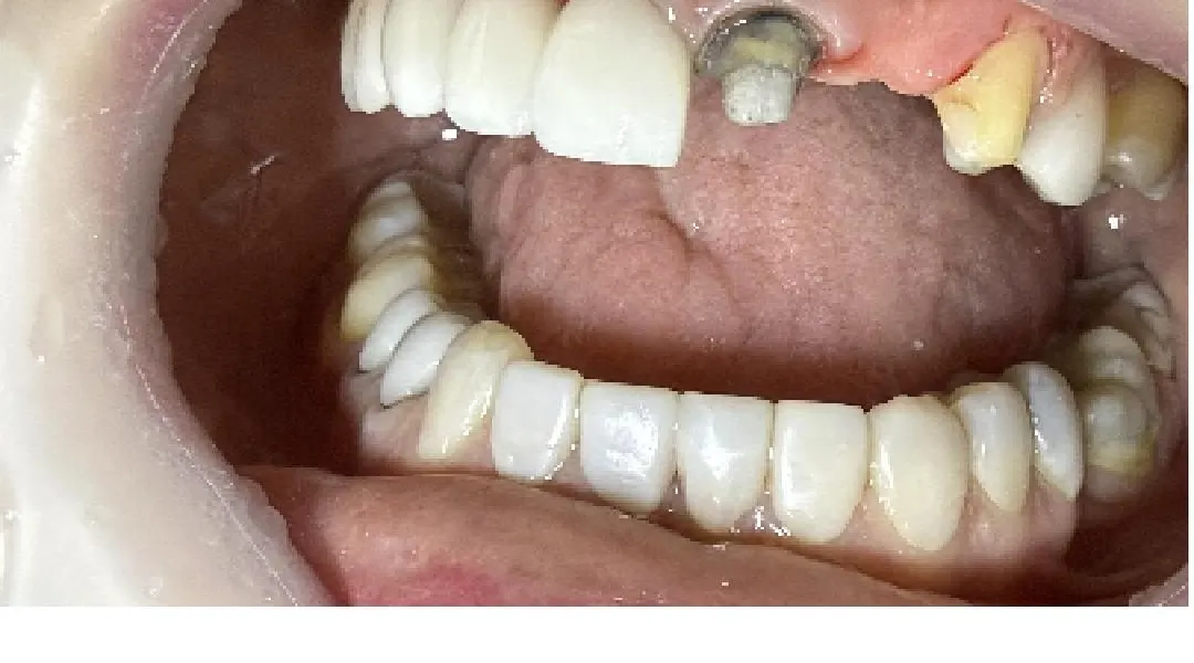 Antes: dientes desgastados y faltantes