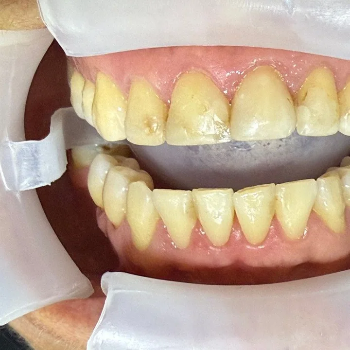 Antes: dientes amarillos y desgastados