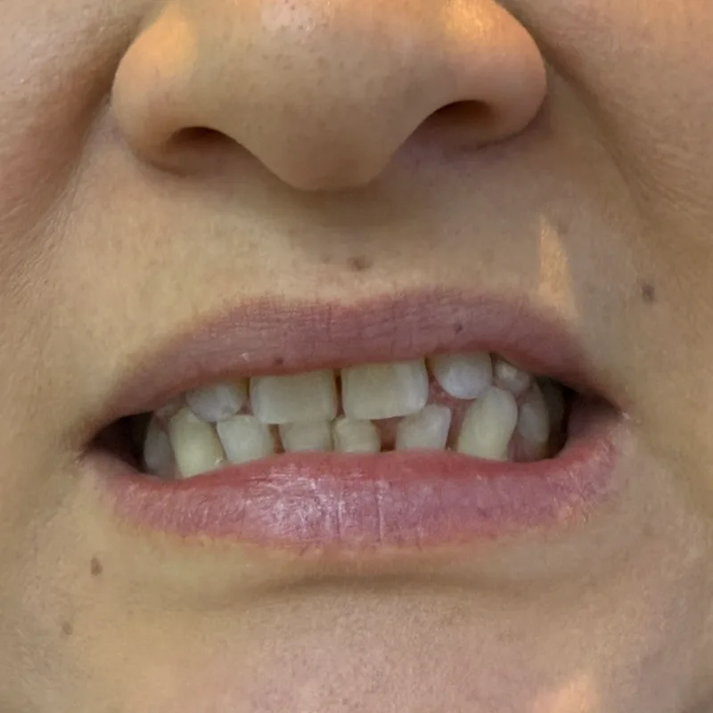 Antes: dientes apiñados y desiguales
