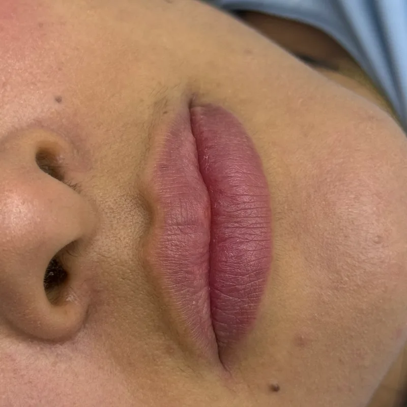 Antes: labios sin definición
