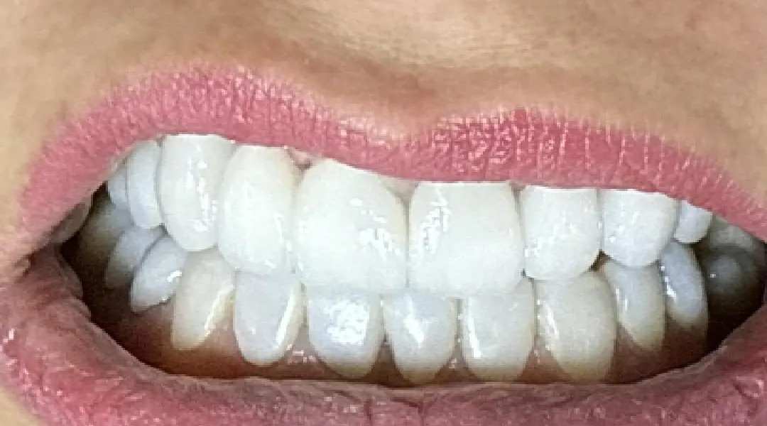 Después: sonrisa rehabilitada