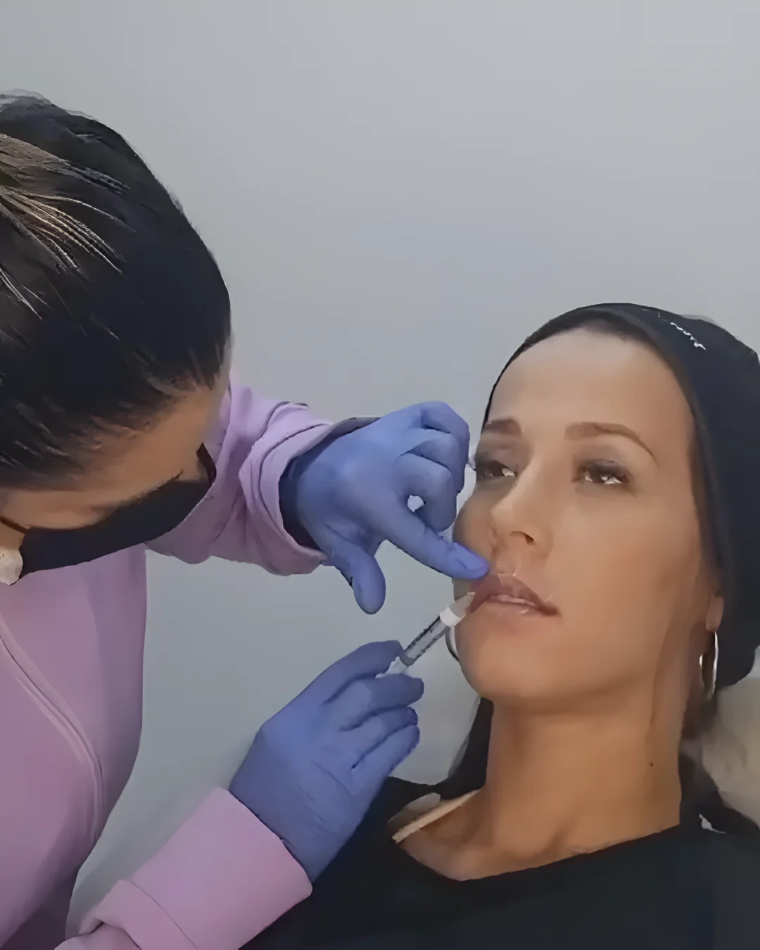 Aplicación con aguja ultrafina en los labios