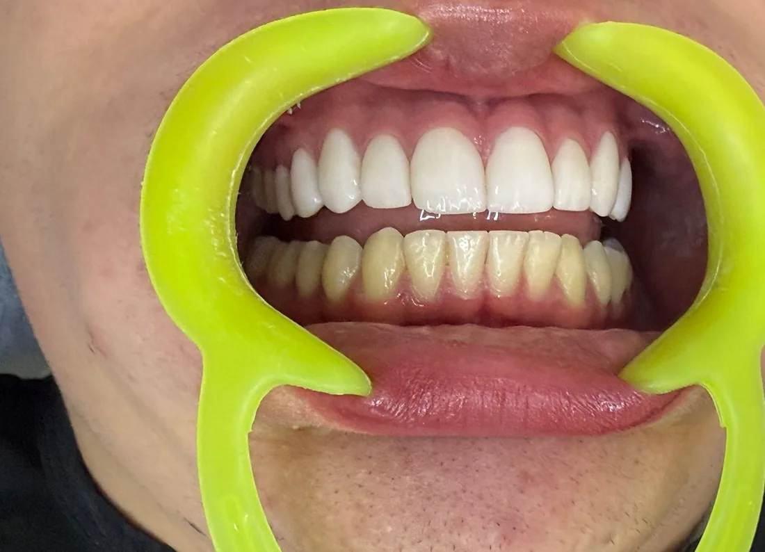 Comparación real: carillas en los dientes superiores frente a los dientes naturales inferiores