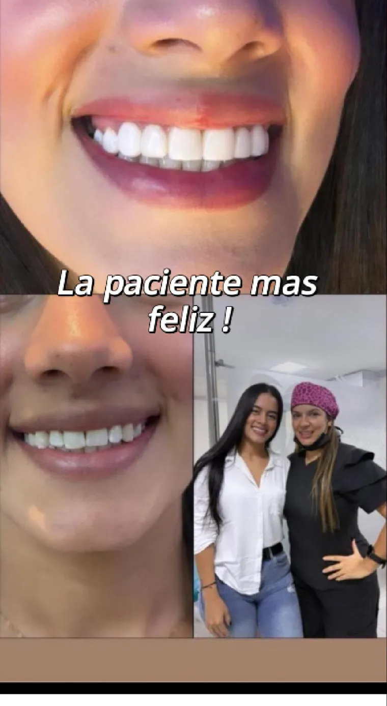 Diseño de sonrisa: antes y después de la paciente